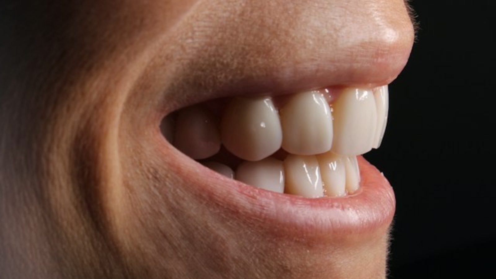 Entrar sin dientes y salir con una sonrisa fija el mismo día: así aplica una clínica de Madrid los implantes de carga inmediata