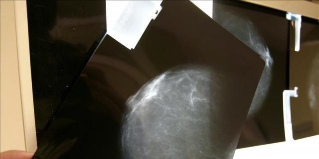 Aprobado el medicamento que reduce un 30% el riesgo de muerte en cáncer de mama