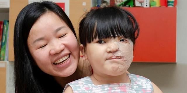 El Gregorio Marañón reconstruye la cara de una niña vietnamita con un tumor vascular