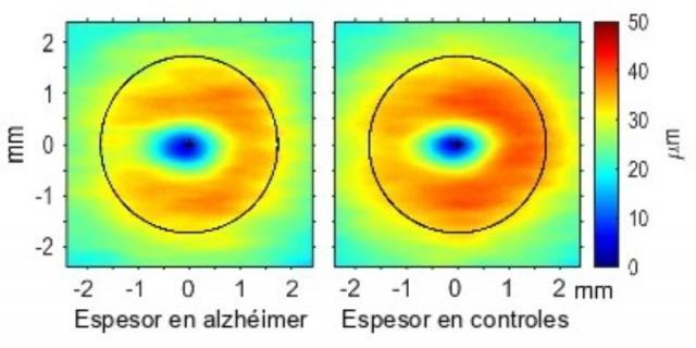 Algunos cambios en la retina pueden adelantar el diagnóstico del alzheimer
