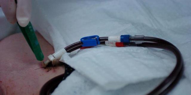 Investigadores logran prevenir la calcificación vascular en la hemodiálisis