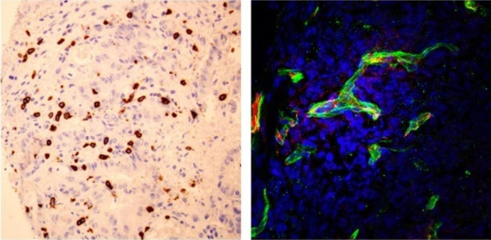 Descubren un biomarcador que predice la eficacia de la inmunoterapia en cáncer