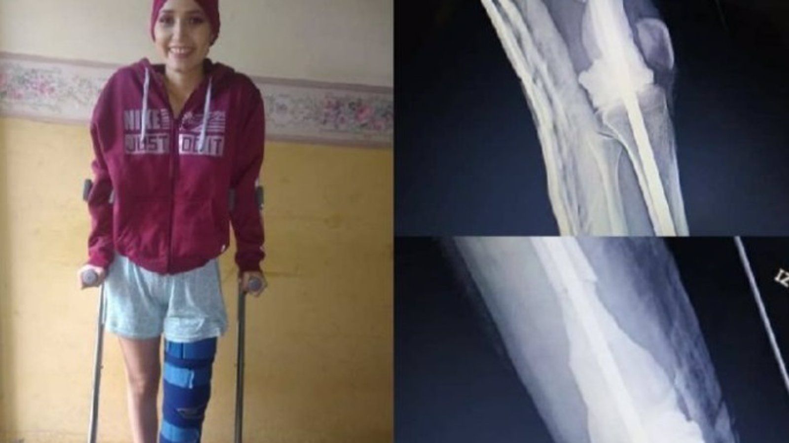 Una joven lanza un crowdfunding para recibir una prótesis no convencional que le permita volver a caminar